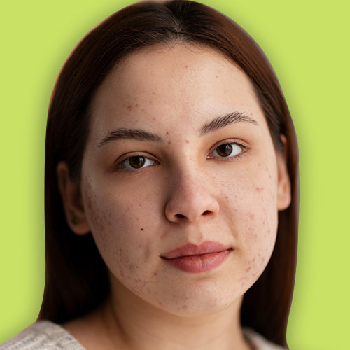 Woman with acne